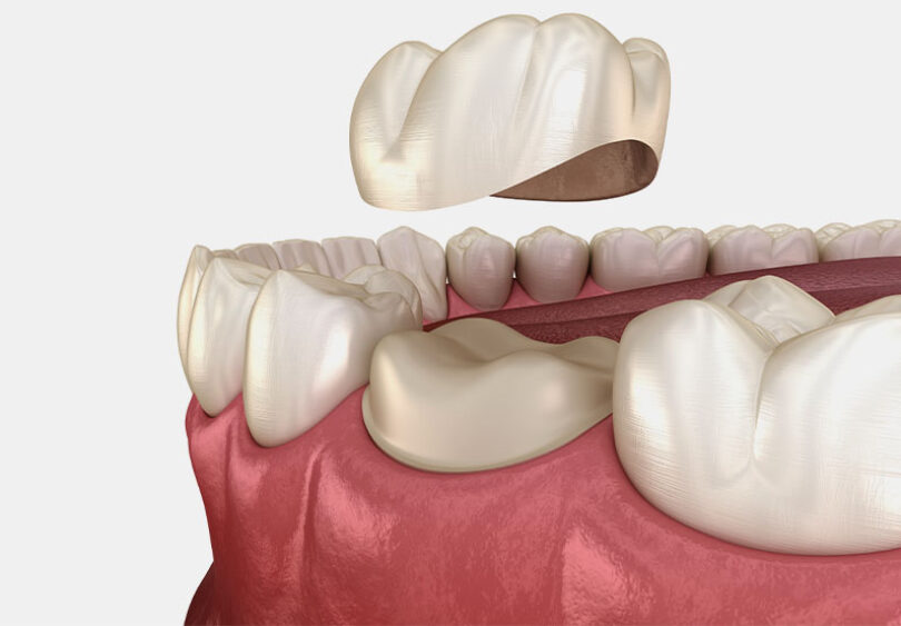 Treatment - Temple Street Dental