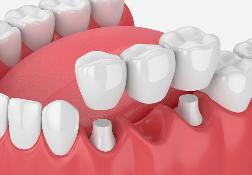 Treatment - Temple Street Dental