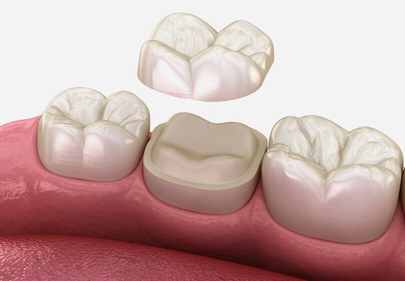 Treatment - Temple Street Dental
